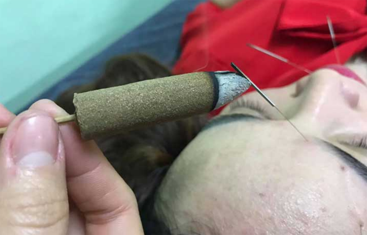 Cứu điều trị suy nhược thần kinh (Kiện vong; Thất miên; Đầu thống)